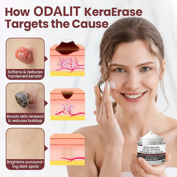 ✅Flash Sale - KeraErase Dual-Action Renewal Cream